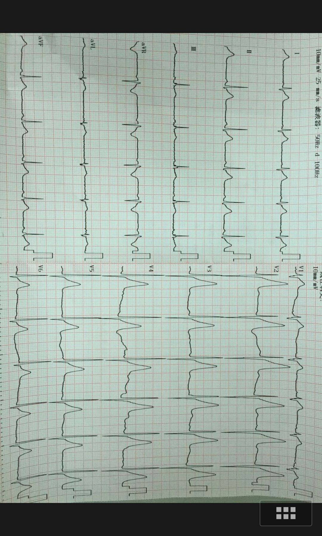左胸刺痛2年,发现心电图t波高尖1年 两年前卧床,大量吸烟后出现左胸