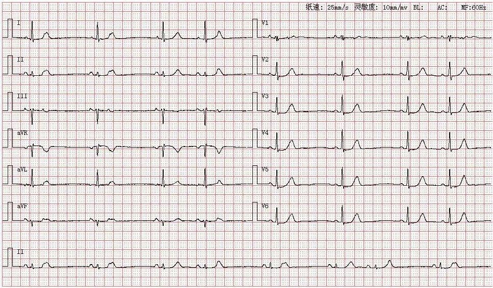 心电图图库丨房性早搏系列