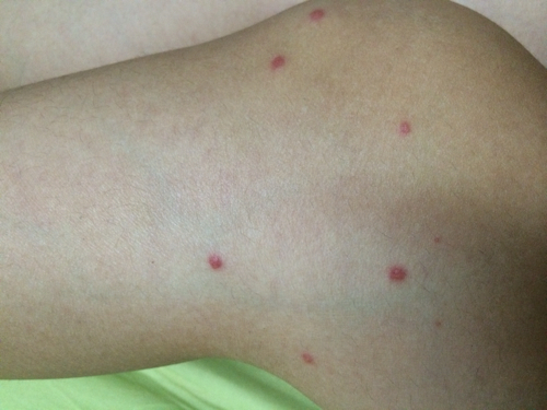 问:腿上胳膊上起了很多红点,后来越来越多,现在红点继发变成小水泡一