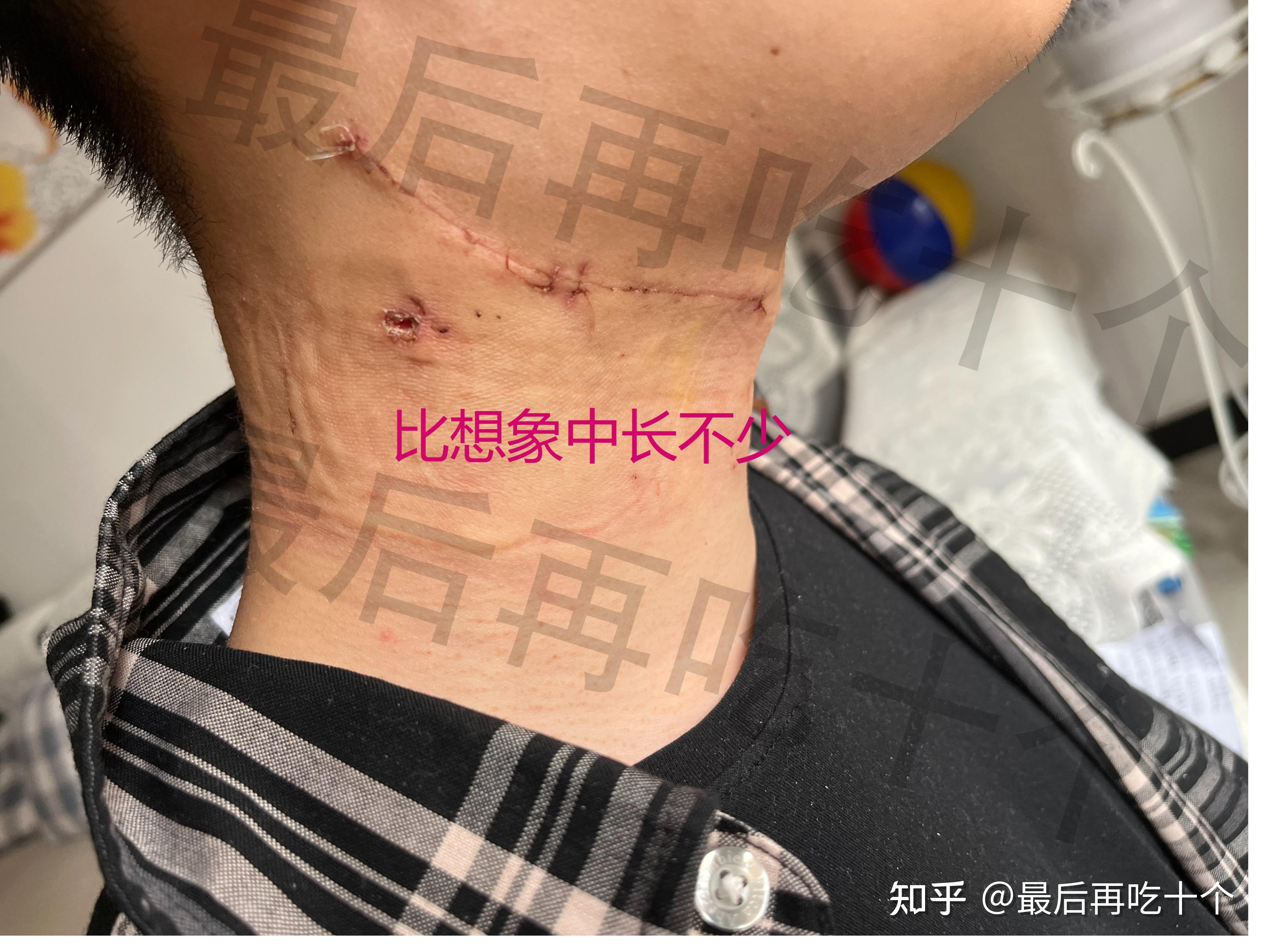 分享我的鳃裂囊肿治疗过程良性颈部肿物