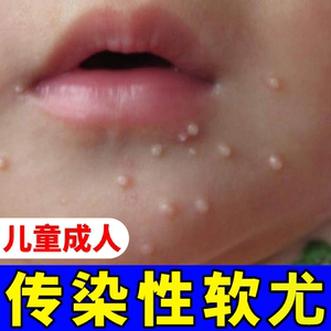 传染性软疣儿童病毒性去软疣膏刮勺镊子去除治工具疗水猴子药