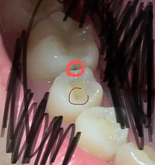 邻面龋真的要好好注意