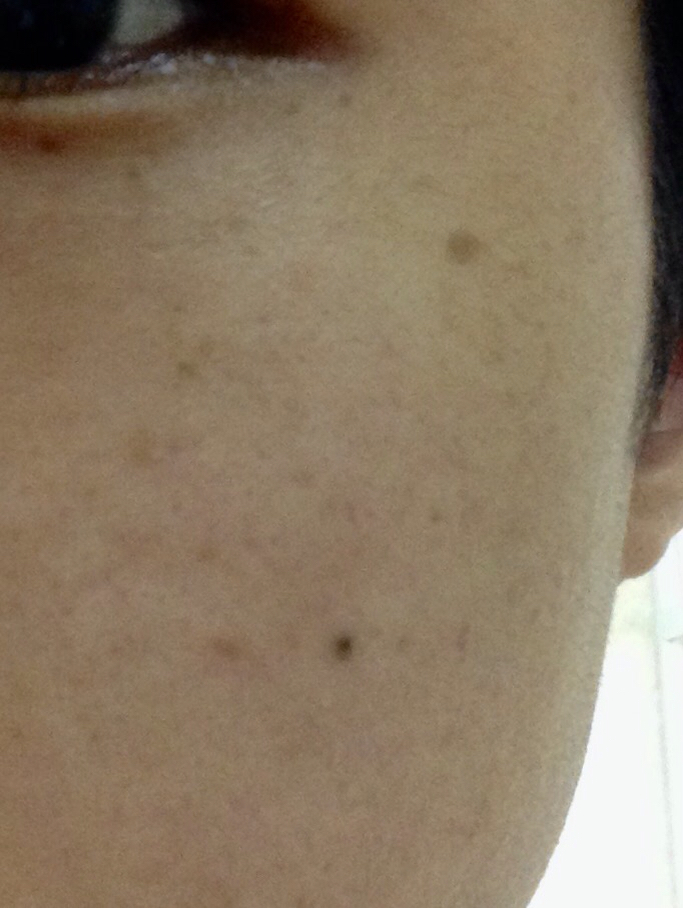 脸上的这些黑点黑块怎么去掉,谁有经济的的方法吗?