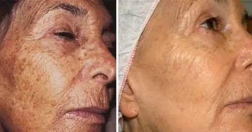 老年斑是怎么形成的这样去掉老年斑更显年轻