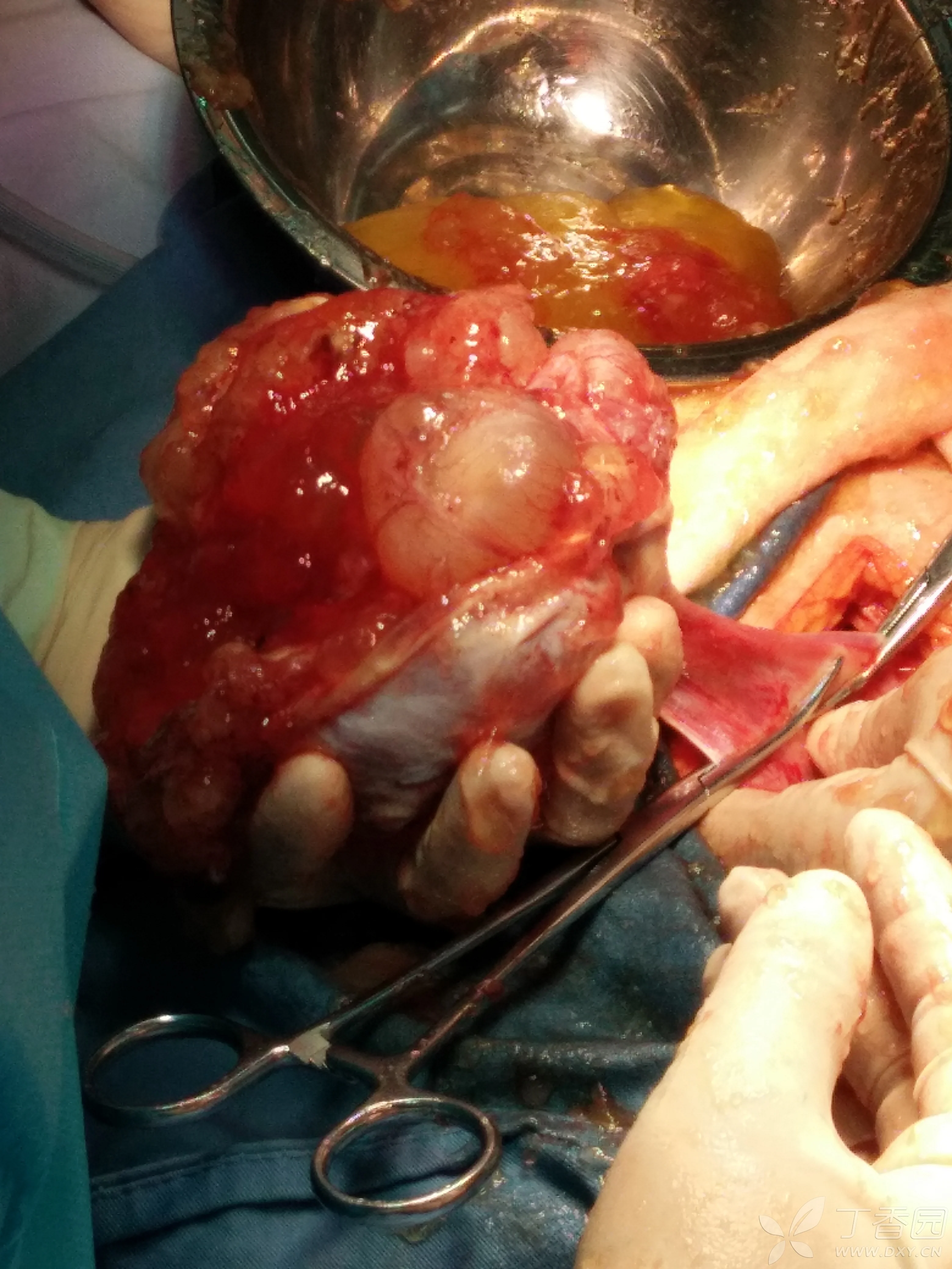 妇产版考考你的基本功# 这是什么类型的肿瘤?(答对有丁当奖励)