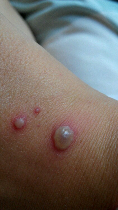 小孩水痘症状图片62