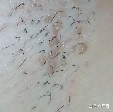 腋下长了好多小疙瘩痒痒的不知道是什么