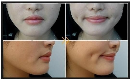 想要做酒窝梨涡成形术 五个方面你要了解下哦