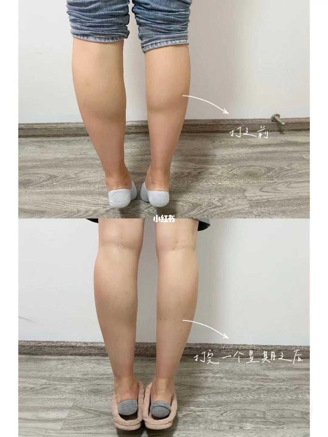 芜湖|瘦腿|瘦小腿|注射瘦腿针 真实对比_瘦腿_瘦腿针_瘦小腿_教程