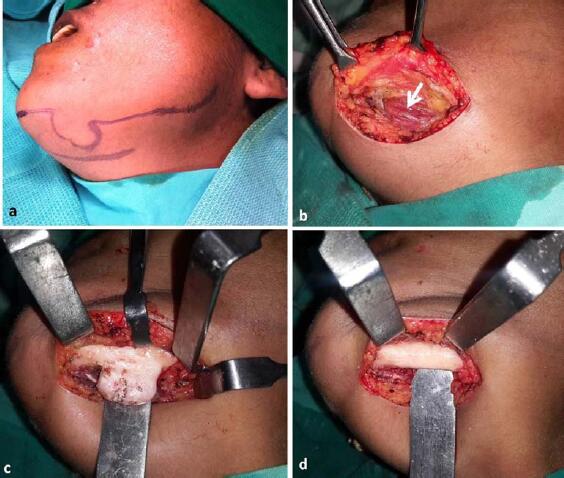 病变的大小和位置,大部分病例是无症状的或表现为缓慢生长的骨性肿物