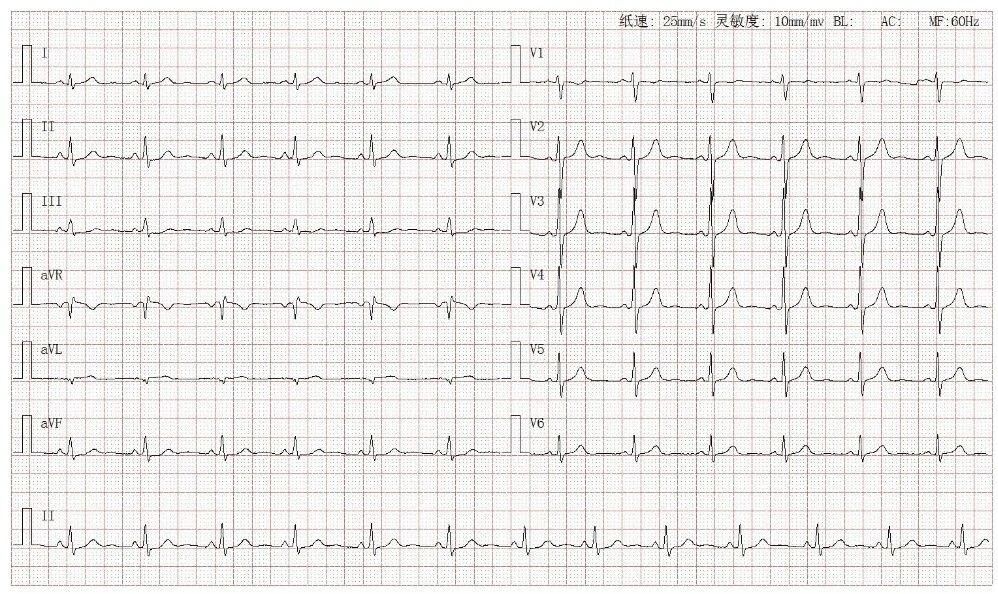 心电图学习|正常心电图 4.