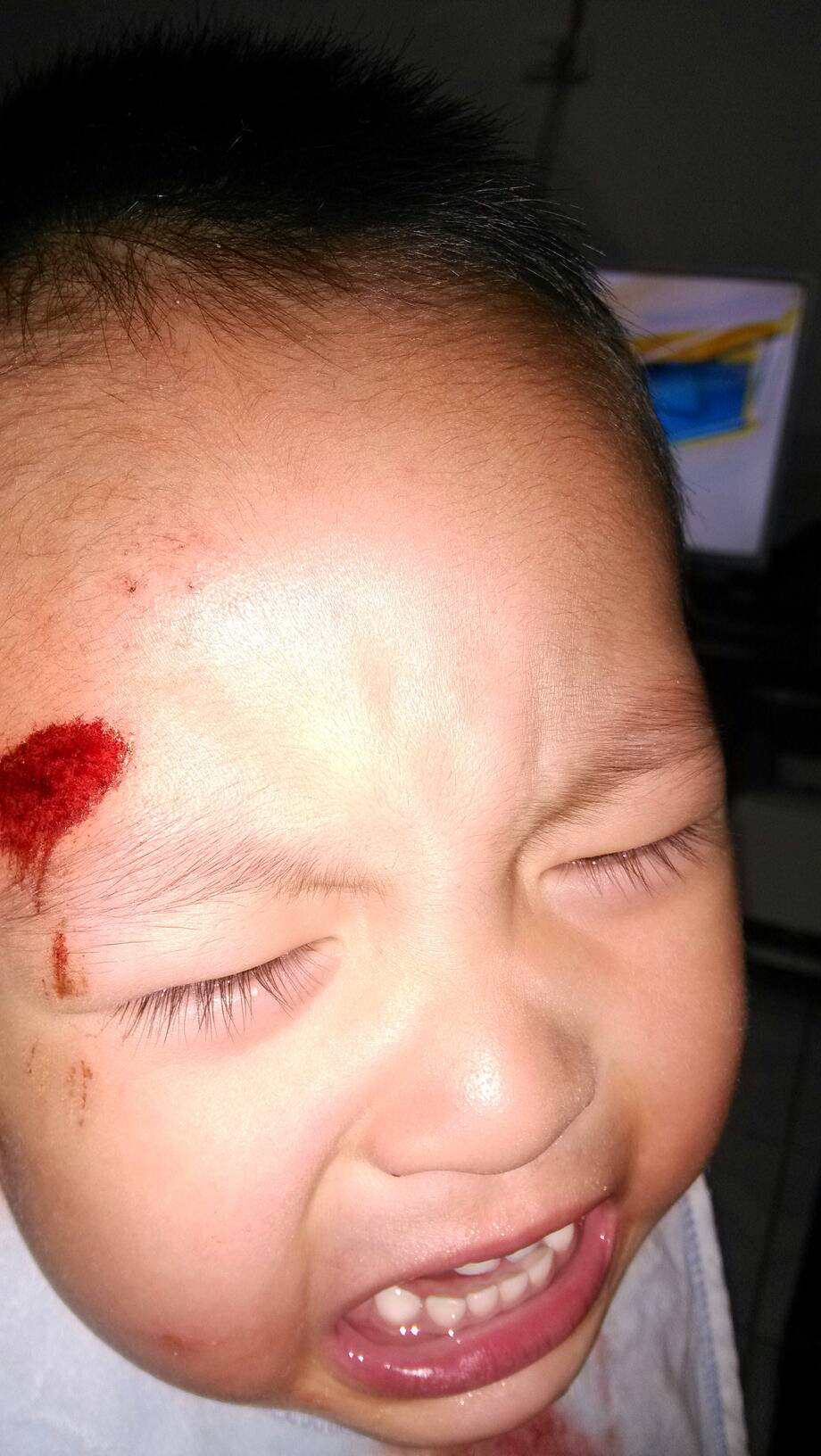 问:小孩走路不小心摔了,额天擦了点皮,请问在家怎么处理?