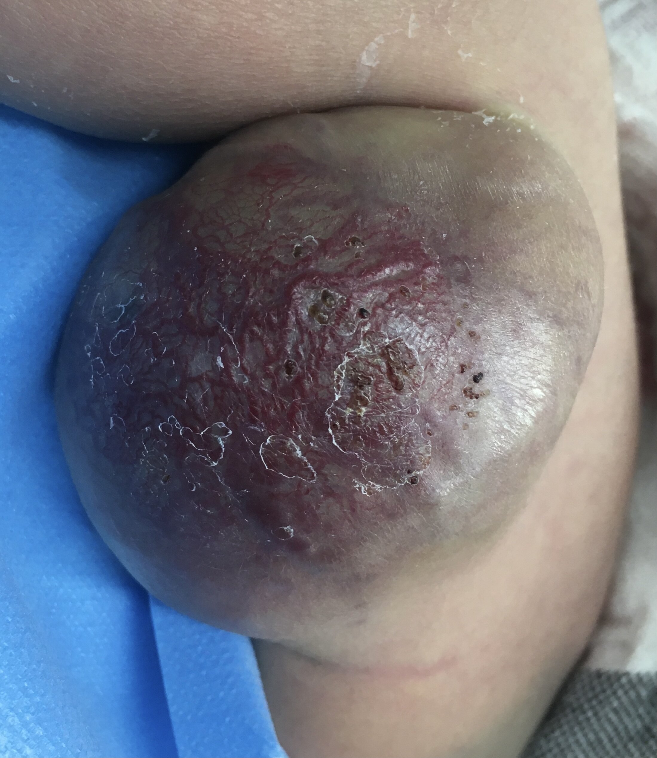 儿童血管畸形/静脉畸形医学科普_血管瘤_介绍_症状表现_治疗方式_日常