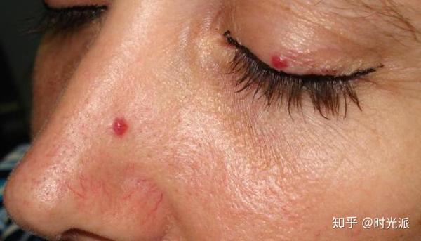 老年性血管瘤("樱桃样"血管瘤)