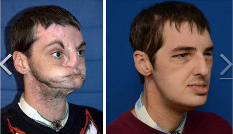 诺里斯,因自杀至严重毁容,右为整容后图片.