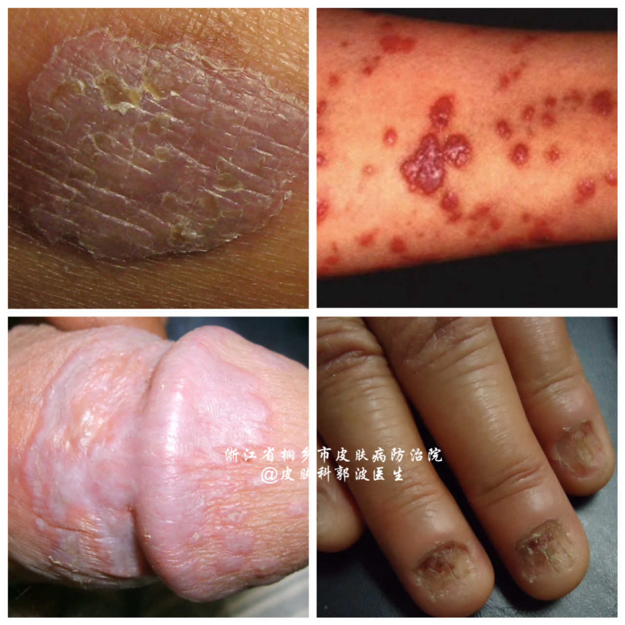 是一种自身免疫性疾病,另外有研究发现有部分患者和丙肝感染也有关系