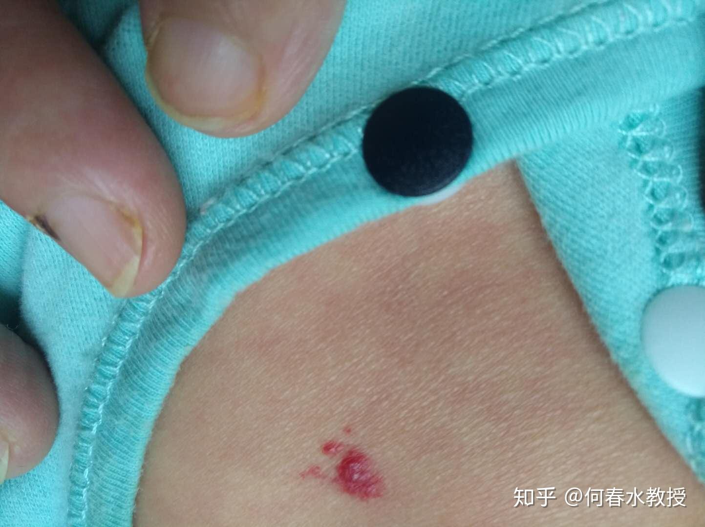 认识婴幼儿血管瘤