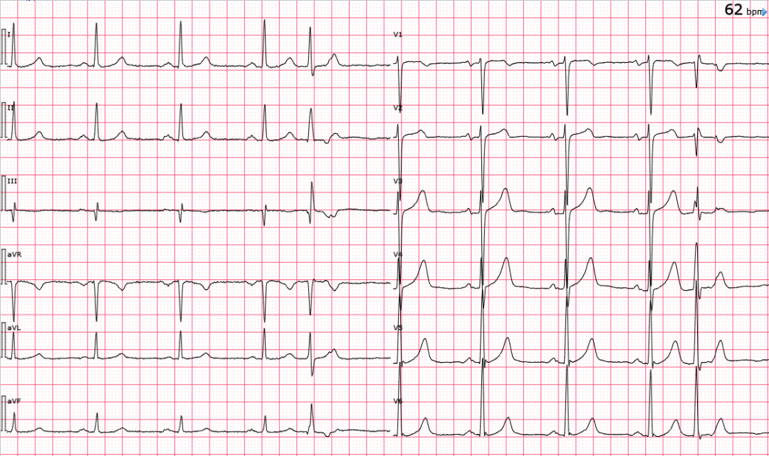 心电图图库丨交界性早搏系列