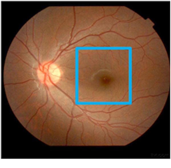 黄斑病变看字扭曲颜色异常