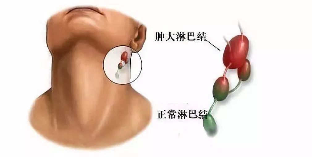 急性淋巴结炎局部先有淋巴结肿大,疼痛和触痛,可与周围软组织分辨