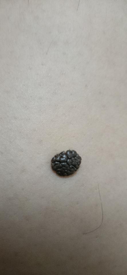 大于10㎜呈菜花状的痣是黑色素瘤吗?