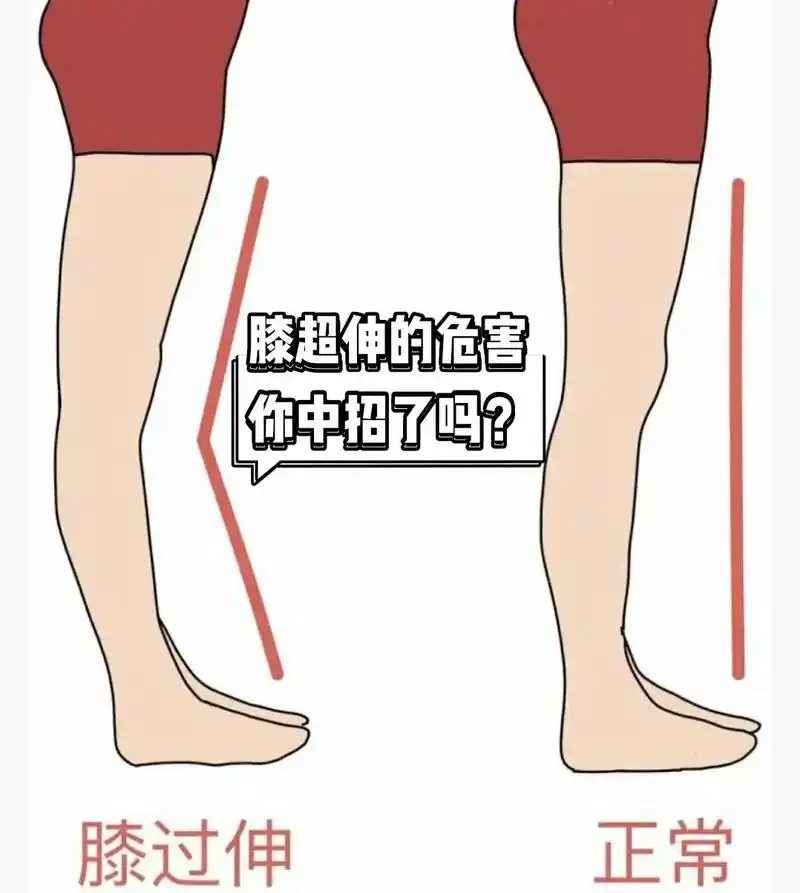 膝超伸,又称"膝过伸 - 抖音