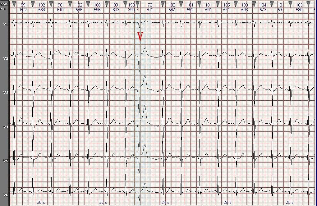心电图病例分析:前壁肌型室性早搏