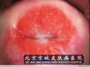 淋病患者要注意哪些事项