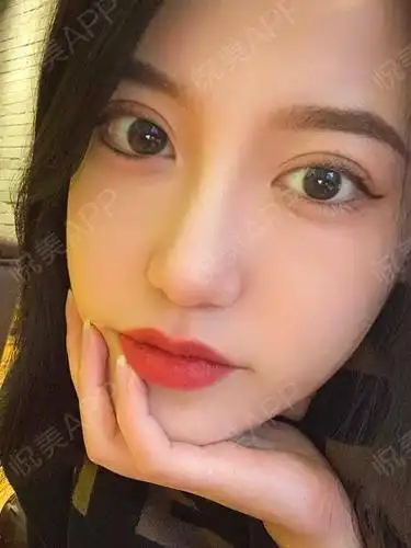 8毫米双眼皮效果图