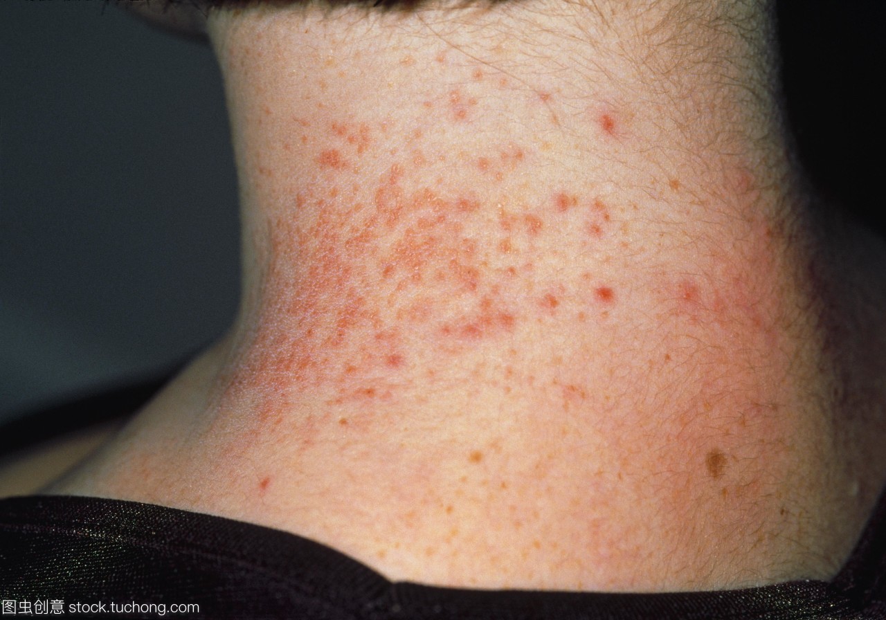 湿疹,皮炎,荨麻疹,皮肤科常见病的诊断及联合用药方案汇总大全