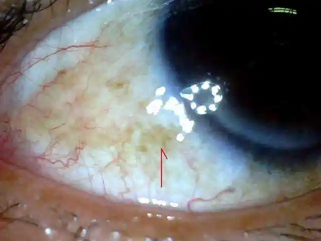 乙肝知识-文章中心-战胜乙肝网