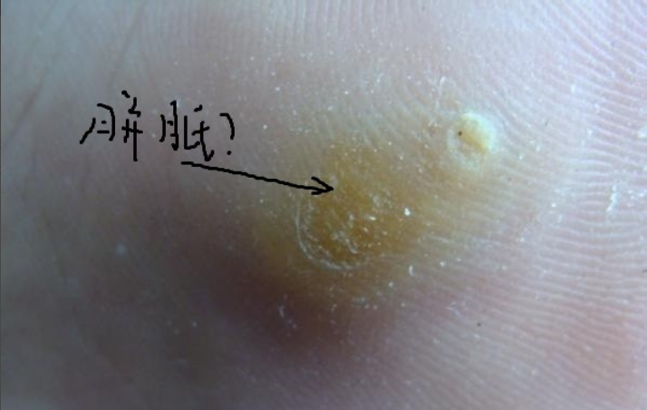 图解跖疣,鸡眼和胼胝三者区别