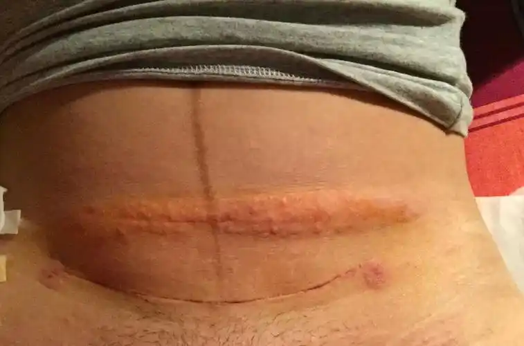 羊水破了肚子不痛,最后医生打了催产针,肚子就开始发作了,可无论怎么