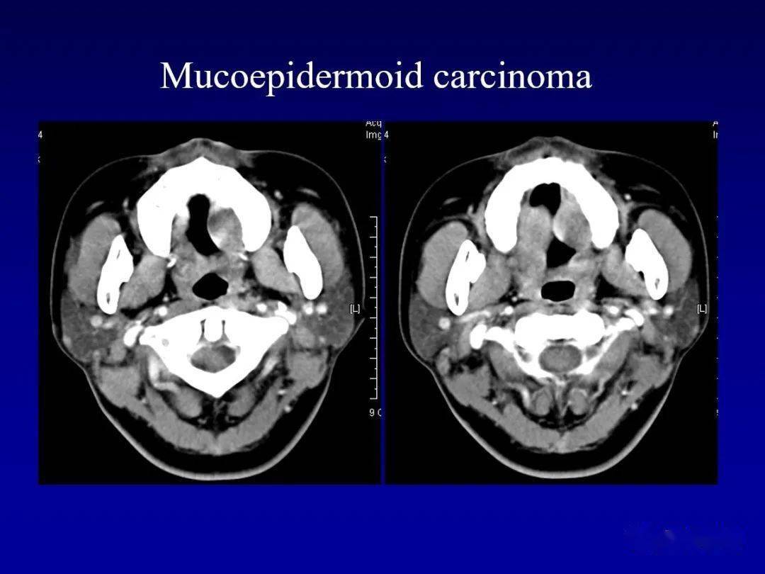 颌面部解剖及其病变的影像诊断