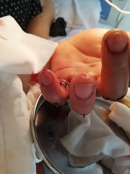 环小指离断再植