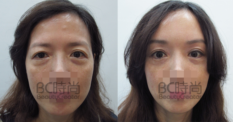 拉皮_内视镜上额提眉拉皮手术(并前额骨瘤磨平及整形胶的应用)