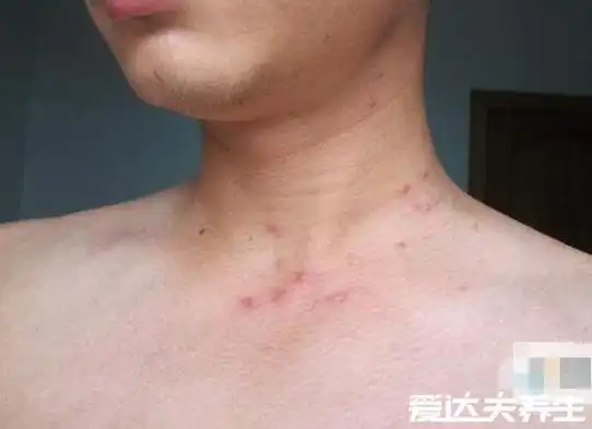 不同时期的艾滋病皮疹图片及症状,不痛不痒的小红点更需注意