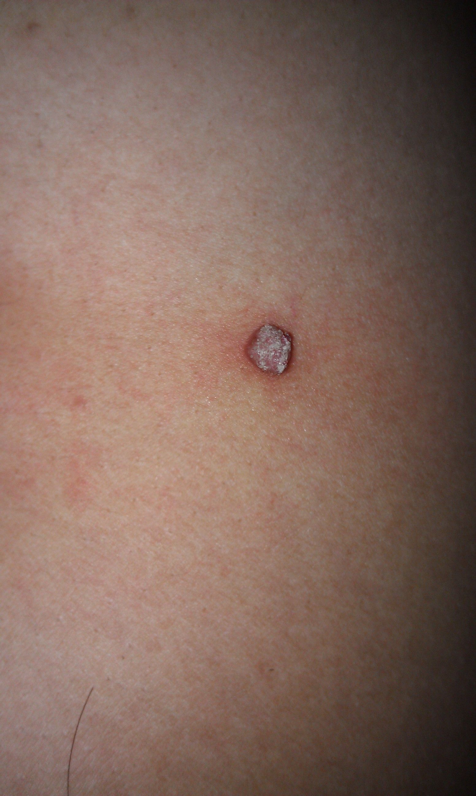 被我用手弄破以后现在长出了个3到4毫米的小肉瘤担心会不会是癌变呢?