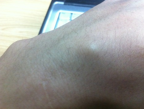 手臂皮下脂肪瘤图片