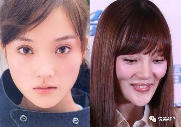 明星毁容大多因中了苹果肌的毒