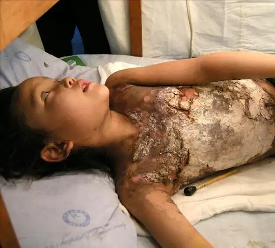 点火解裙被烧伤女孩巧巧平安归校