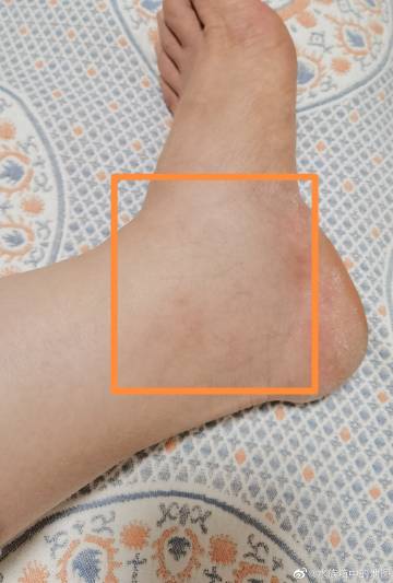 孕35w3d,今天下班到家发现左脚肿了   北京