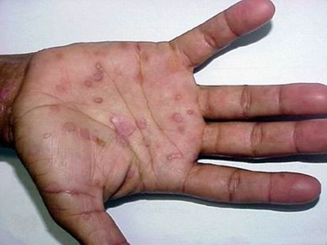 一期梅毒初期生殖器图片