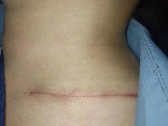 不过我这个好在在锁骨那里,穿衣服能挡住,下面这照片是手术后不到俩月