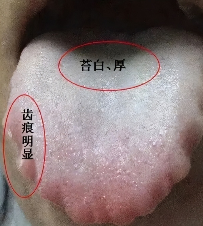 湿气重,舌苔白腻,就不能纯补.