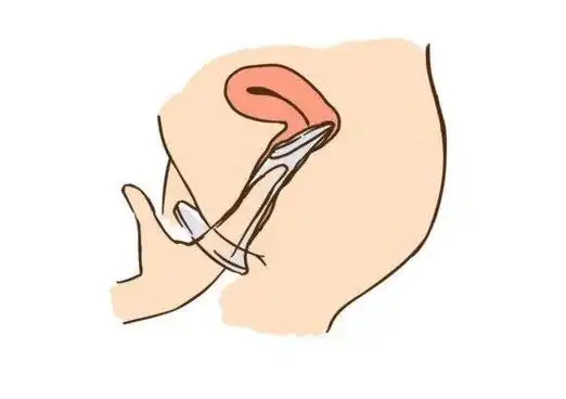 置入时,捏紧内环,将套送入阴道内,直至感觉已到正确位置即可