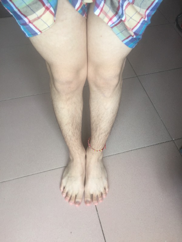 男性,这种腿型正常吗?