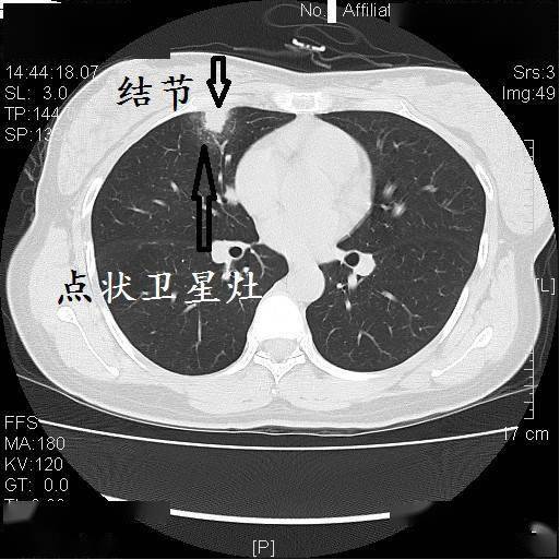 十二个病人的肺ct图像详细解读!_结核