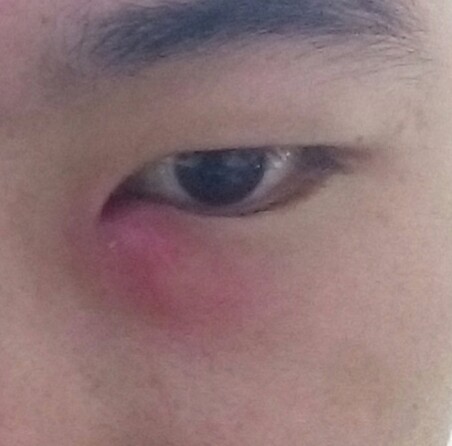 眼角附近肿起一个包,现在是第六天,刚开始前三到四天的时候,按压有