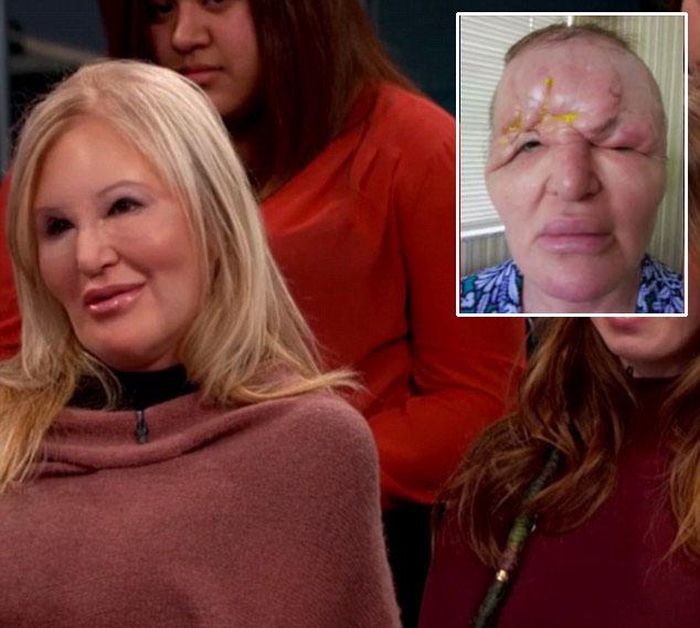 美国一大妈整容手术失败额头变形酷似外星人